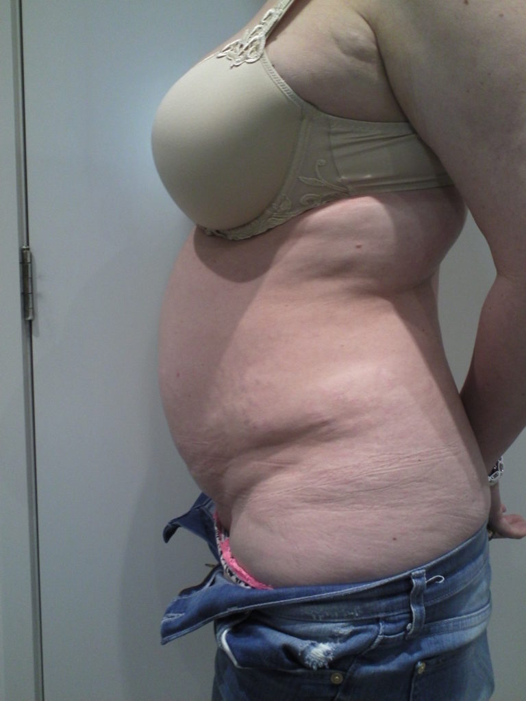 Tummy Tuck Before and After Photos NZ - Dr Mark Gittos Plastic Surgeon